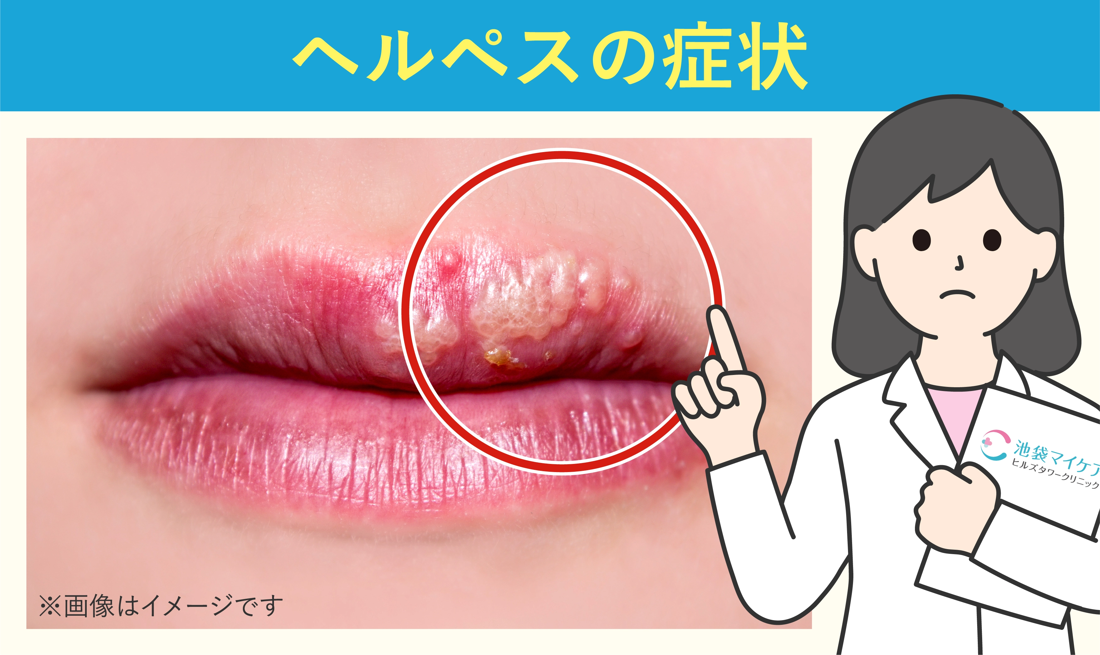 ヘルペスの症状