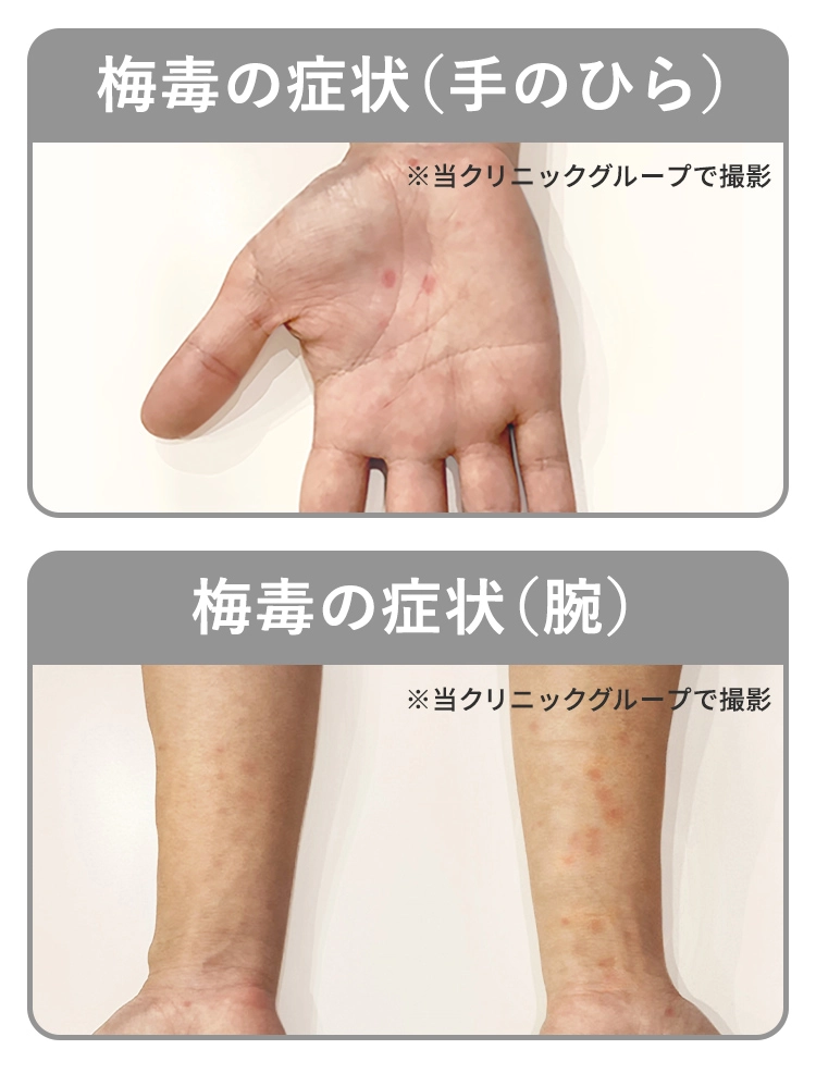 クラミジアは気づかないうちに感染が進行することも。尿道の不快感や軽い痛み、膿のような分泌物がある男性や、おりものの変化や下腹部の鈍痛がある女性は早めの検査がおすすめ。不妊やパートナーへの感染リスクも。