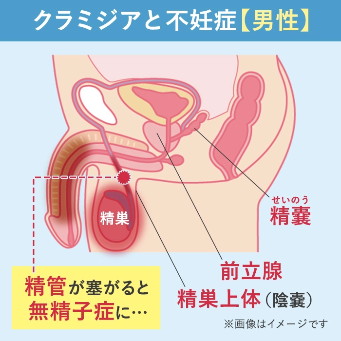 クラミジア感染と男性の不妊について