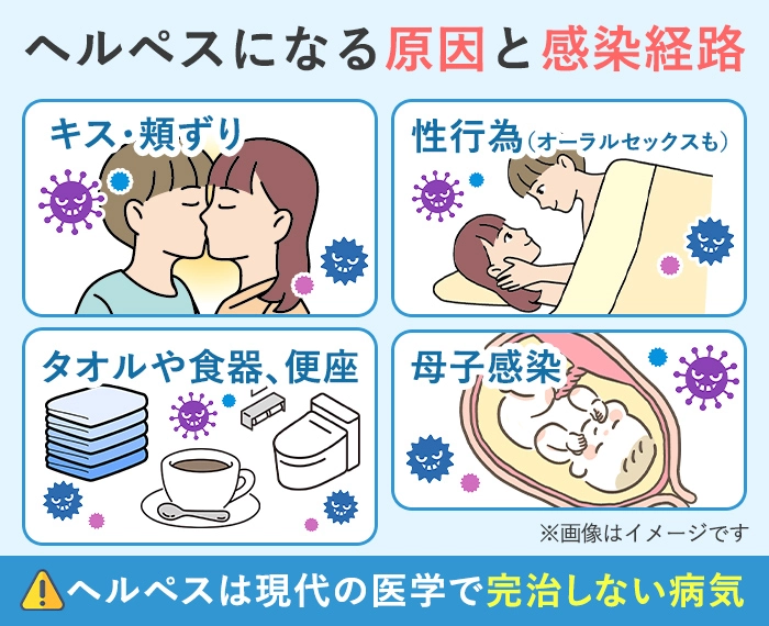 ヘルペスになる原因と感染経路