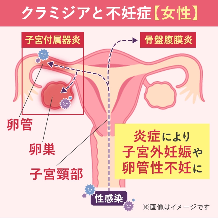 クラミジア感染と女性の不妊について