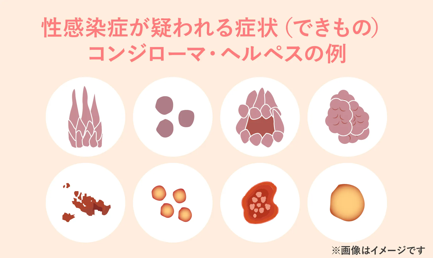 デリケートゾーンのかゆみの原因となる性感染症