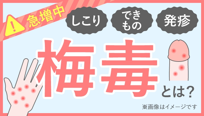 梅毒は梅毒トレポネーマが原因で起こる全身性の感染症