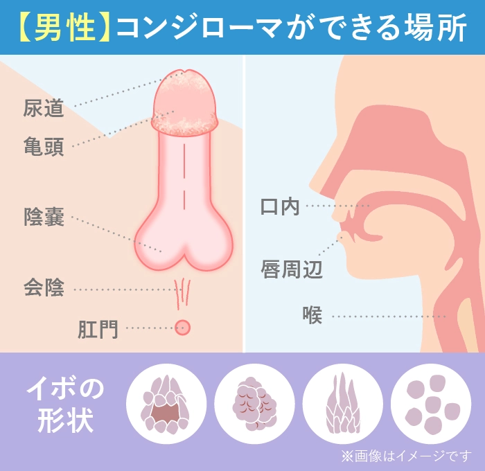 男性の尖圭コンジローマの感染部位