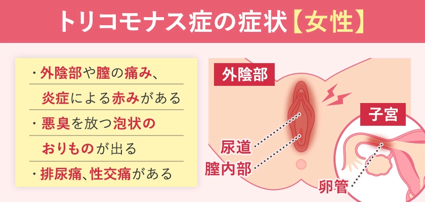 女性のトリコモナス症の症状