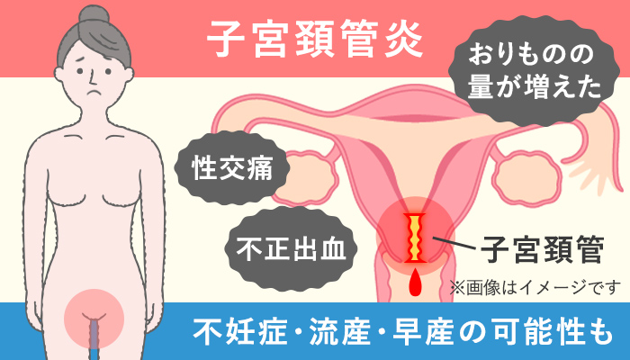 淋菌感染症（淋病）の女性の症状