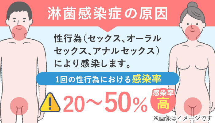 淋菌感染症（淋病）の原因と感染確率