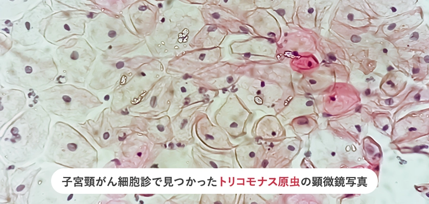 膣トリコモナスの顕微鏡写真