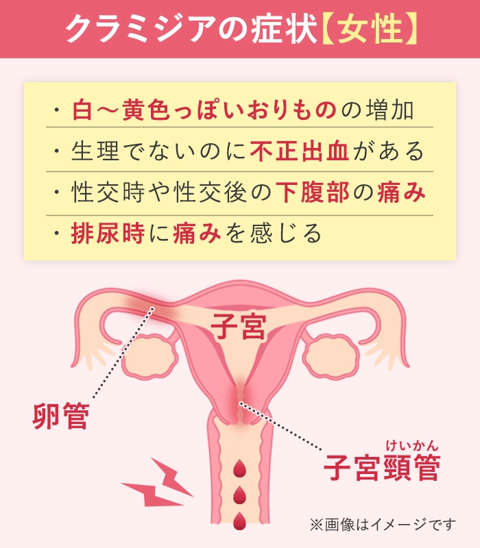 女性のクラミジアの症状