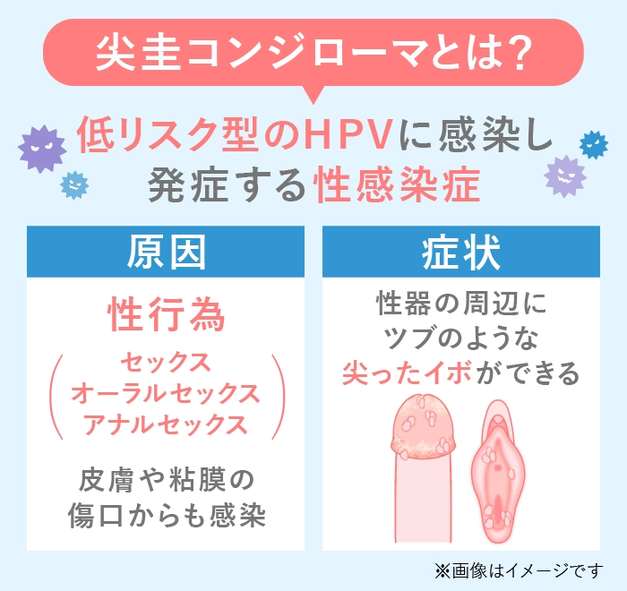 尖圭コンジローマの原因と症状