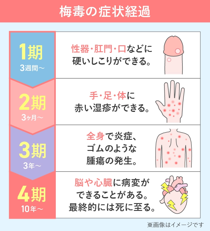 梅毒の症状は病期によって異なる