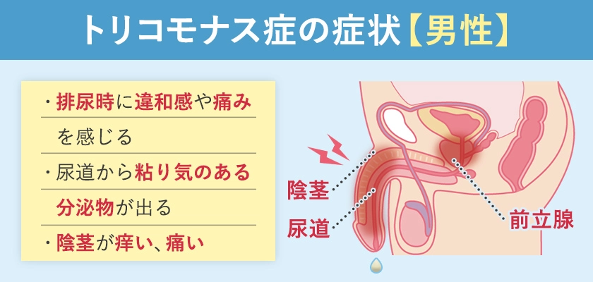 男性のトリコモナス症の症状