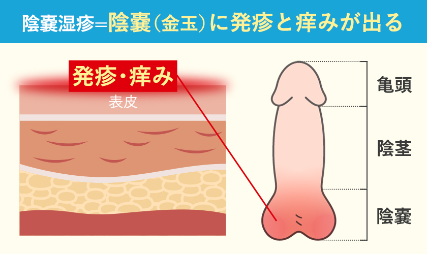 陰嚢湿疹の症状が現れる場所