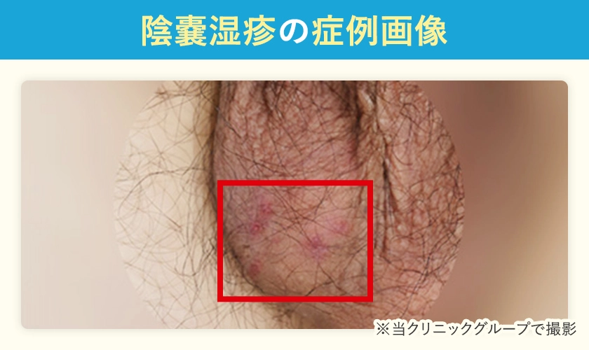 陰嚢湿疹の症例画像