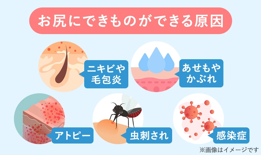 お尻にぶつぶつができる原因の一覧