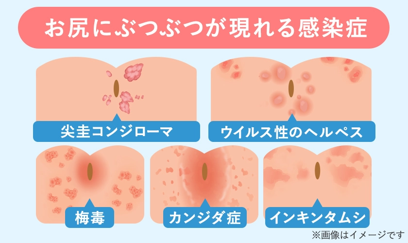 お尻にぶつぶつができる性感染症一覧