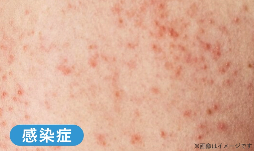 性感染症によってお尻にぶつぶつが発症している様子のイメージ画像