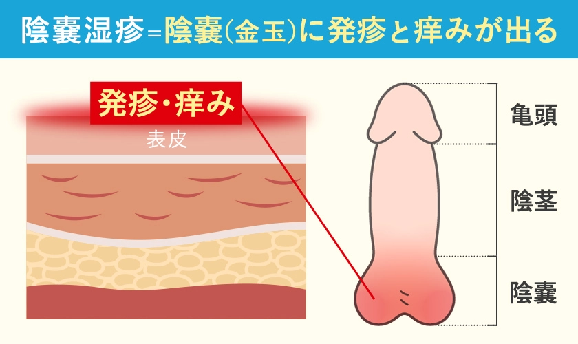 陰嚢湿疹の症状が現れる場所