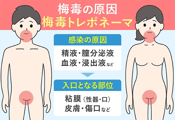 梅毒の原因は梅毒トレポネーマ