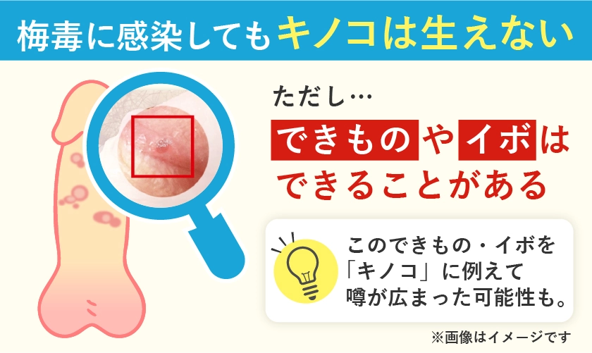 梅毒に感染してもキノコは生えません