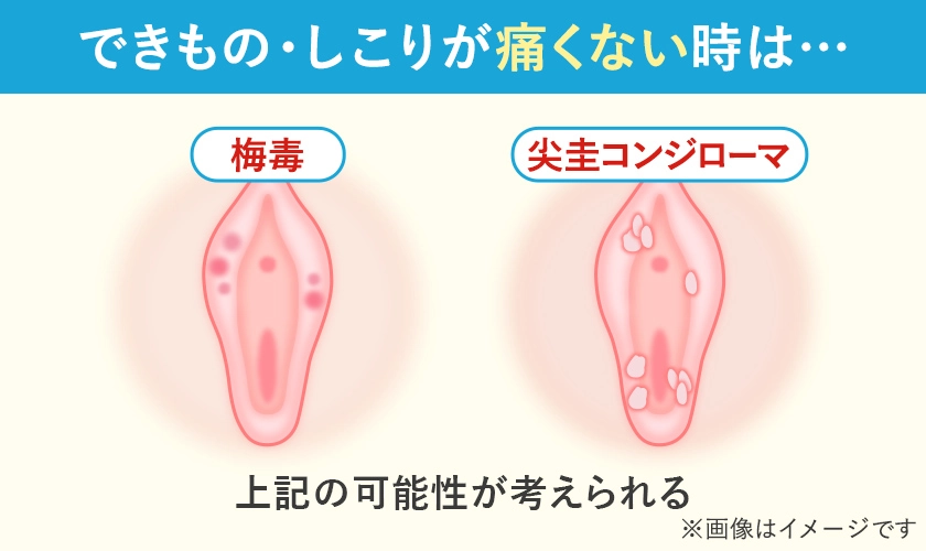 陰部(女性)できものしこりが痛くない時は