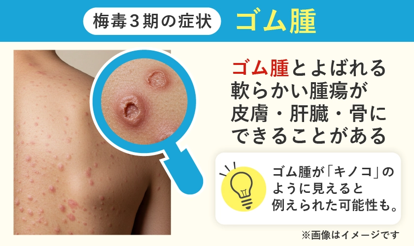 梅毒のゴム腫はキノコのような症状です