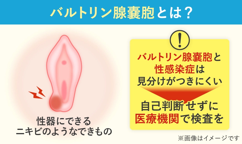バルトリン線嚢胞とは