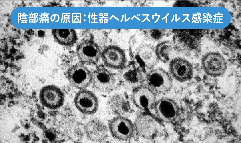 単純ヘルペスウイルス2型の電子顕微鏡像