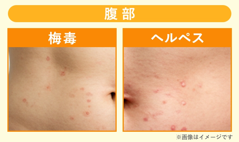 梅毒とヘルペスの症例写真【腹部】