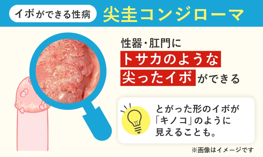 イボがキノコのように見える尖圭コンジローマ