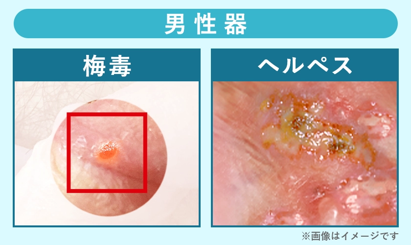 梅毒とヘルペスの症例写真【男性器】