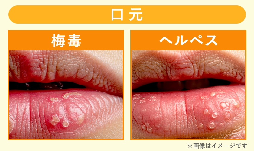 梅毒とヘルペスの症例写真【口元】