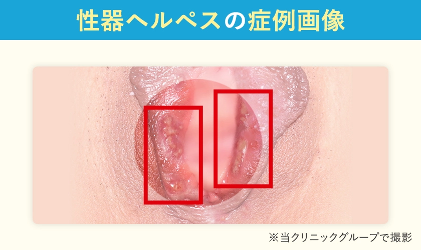 性器ヘルペスの症例画像