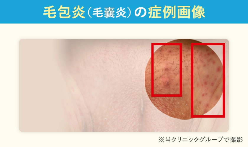 毛包炎(毛嚢炎)の症例画像