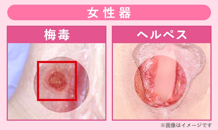 梅毒とヘルペスの症例写真【女性器】