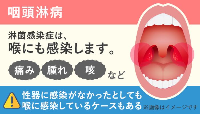 淋菌感染症(淋病)の喉の症状