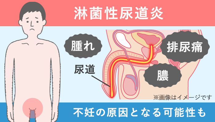 淋菌感染症(淋病)の男性の症状