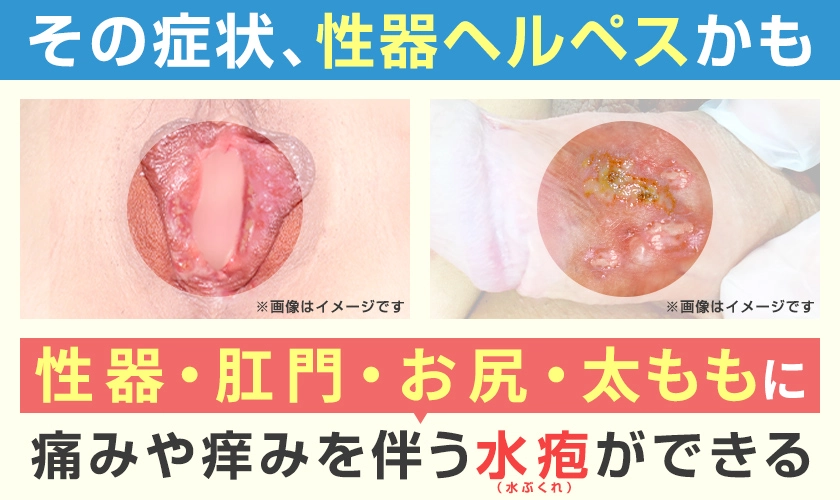 性器ヘルペスの症例画像と症状