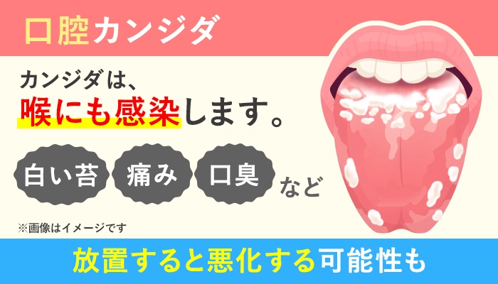 口内や喉のカンジダ症の症状