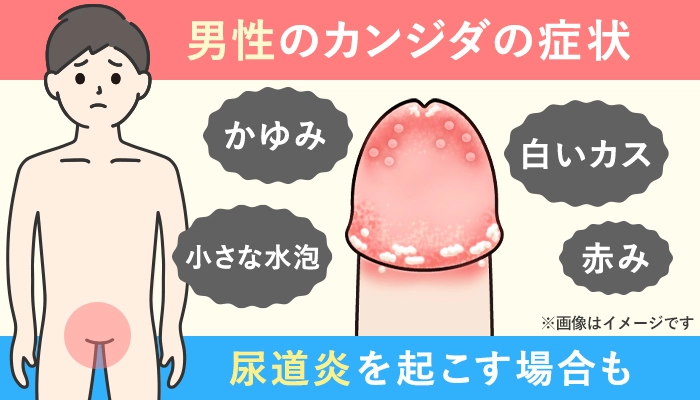 男性のカンジダ症の症状