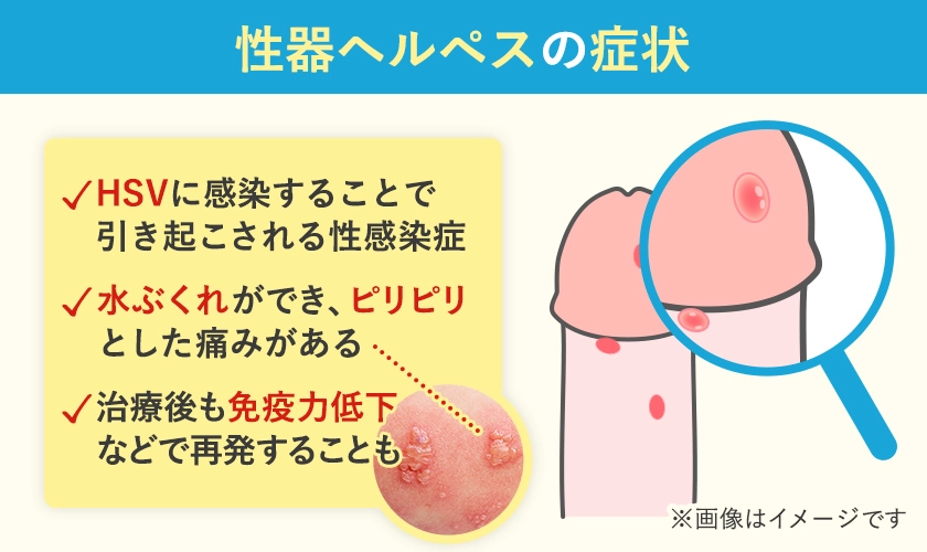 性器ヘルペスの症状の一覧