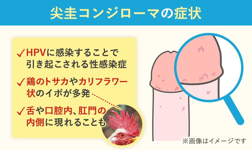 尖圭コンジローマの症状の一覧