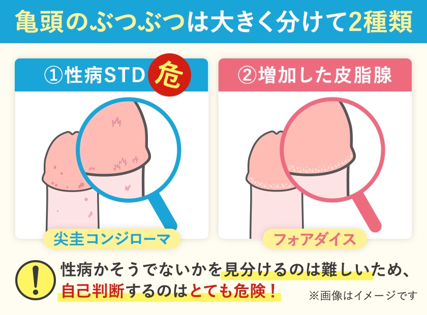 亀頭のぶつぶつは大きく分けて2種類