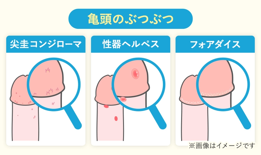 亀頭のぶつぶつの原因一覧
