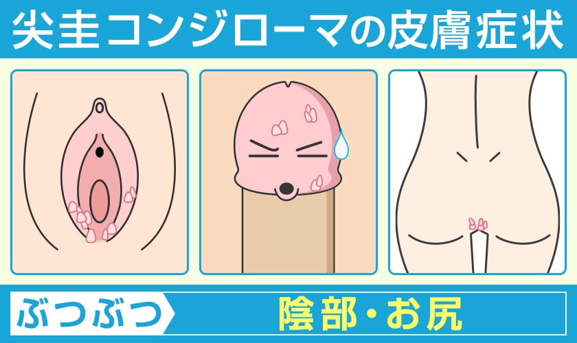 尖圭コンジローマの皮膚症状 陰部やお尻に痛みのない尖ったぶつぶつができる