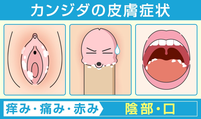 カンジダの皮膚症状 陰部や口に痒み・痛み・赤みなどの皮膚症状