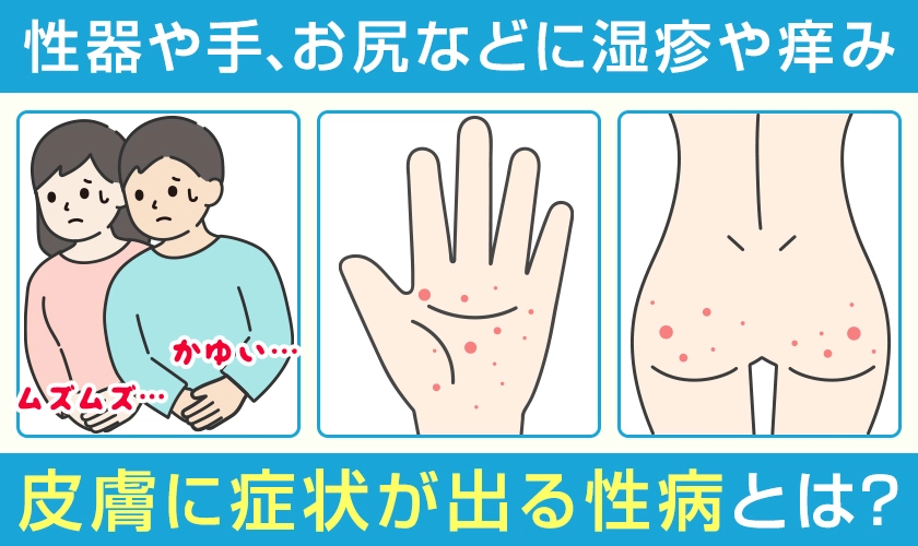 性器や手、お尻などに湿疹や痒み、皮膚に症状が出る性病とは?
