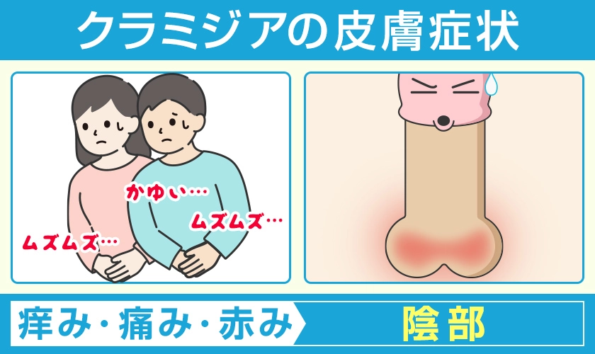 クラミジアの皮膚症状 陰部に痒み・痛み・赤みなどの皮膚症状