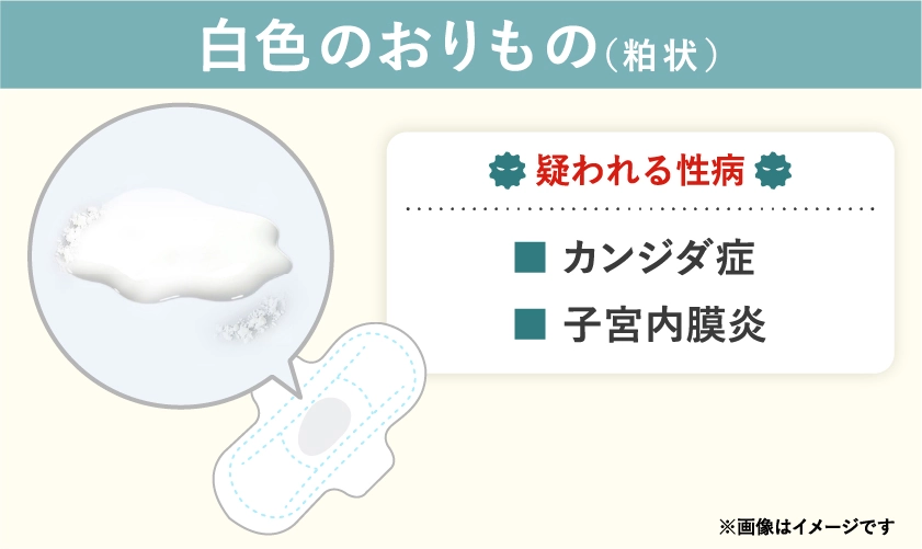 白色のおりもので疑われる病気や性病