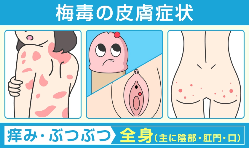 梅毒の皮膚症状 主に陰部・肛門・口などに痒みやぶつぶつなどの皮膚症状